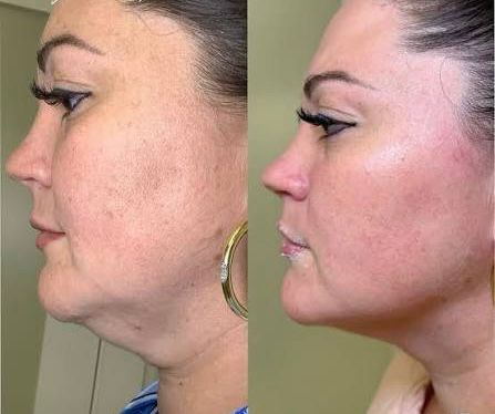 Lower Face Lift
